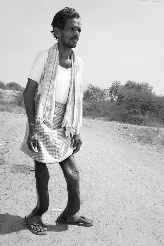 Rural Drinking Water Challenges - A 35 years old man affected by acute skeletal fluorosis due to fluoride-contaminated drinking water in a village in Nalgonda district, Telangana